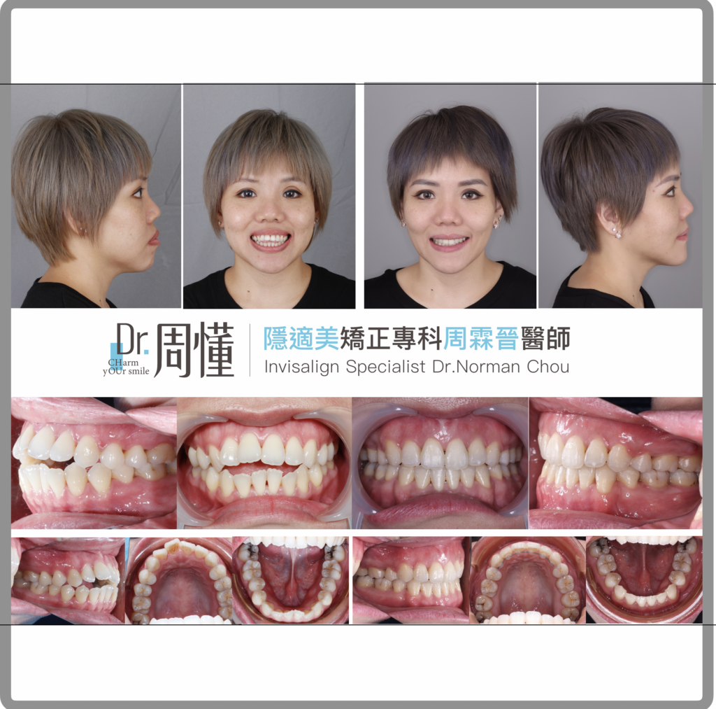 矯正案例 - 暴牙合併深咬 - 台南北區牙醫推薦綠芽牙醫診所