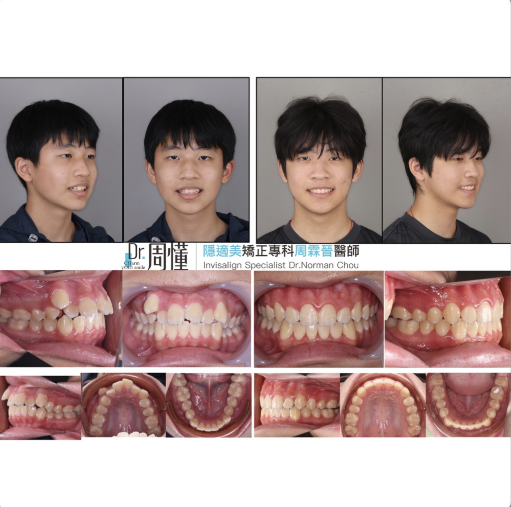 兒童矯正牙齒案例圖,從凌亂到整齊
