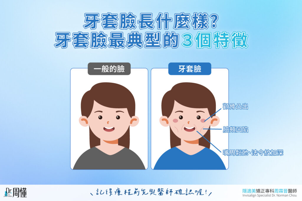 牙套臉長什麼樣?牙套臉最典型的 3 個特徵