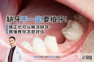 缺牙不一定要植牙!矯正也可以解決缺牙,周懂教你怎麼評估|周霖晉醫師