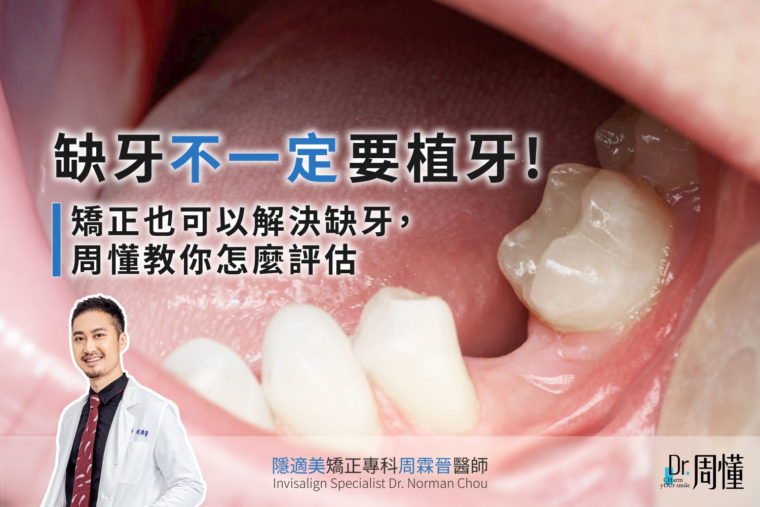 缺牙不一定要植牙！矯正也可以解決缺牙，周懂教你怎麼評估｜周霖晉醫師